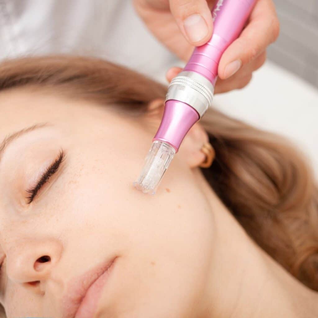 microneedling rimpolpante viso